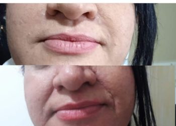 Líneas de nazogeneanos 2