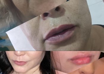 Relleno de labios con ácido hialurónico